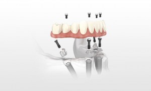 All-on-4 dental implants