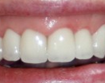 teeth whitening basingstoke Teeth whitening Basingstoke