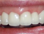 Teeth whitening Basingstoke