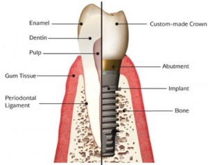 Dental Implants Basingstoke