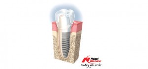 Neodent Straumann Implants